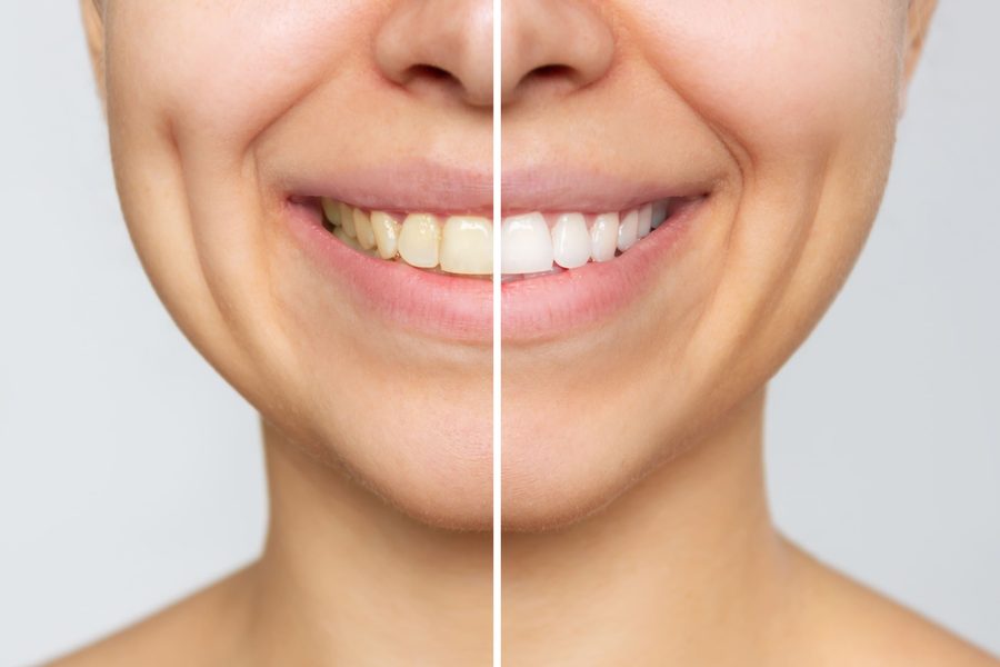 Antes y después de blanqueamiento dental en Cajicá - caso 1