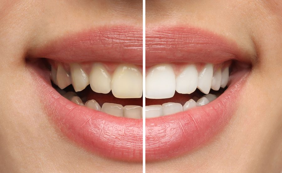 Antes y después de blanqueamiento dental en Cajicá - caso 2