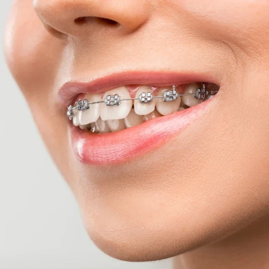 Brackets autoligados Cajicá