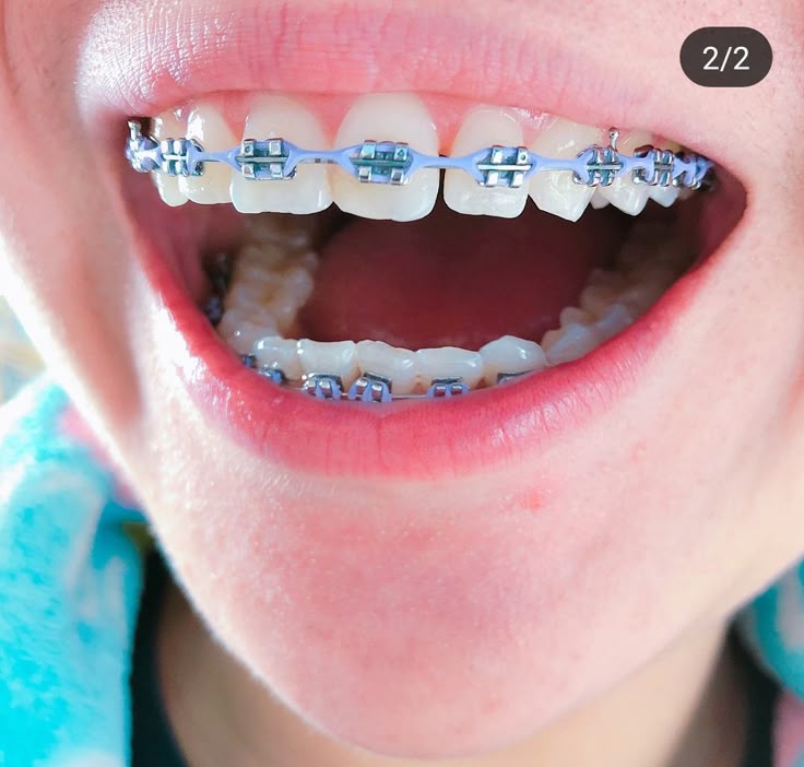 Brackets metálicos Cajicá