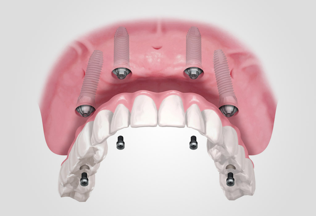 Implantes All-on-4 en Cajicá