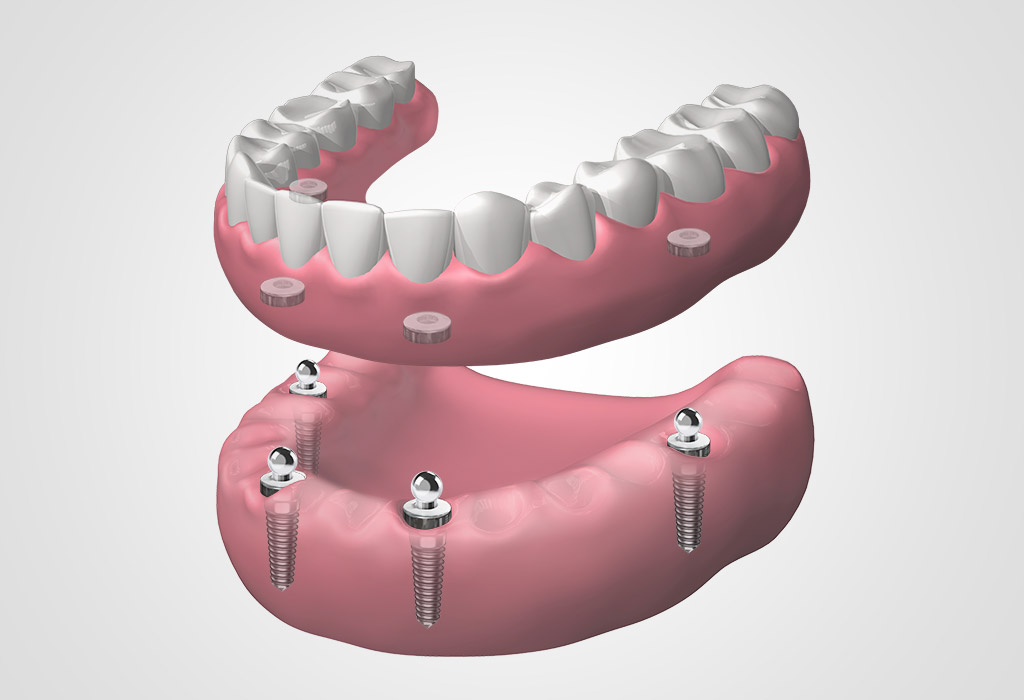 Implantes de boca completa en Cajicá
