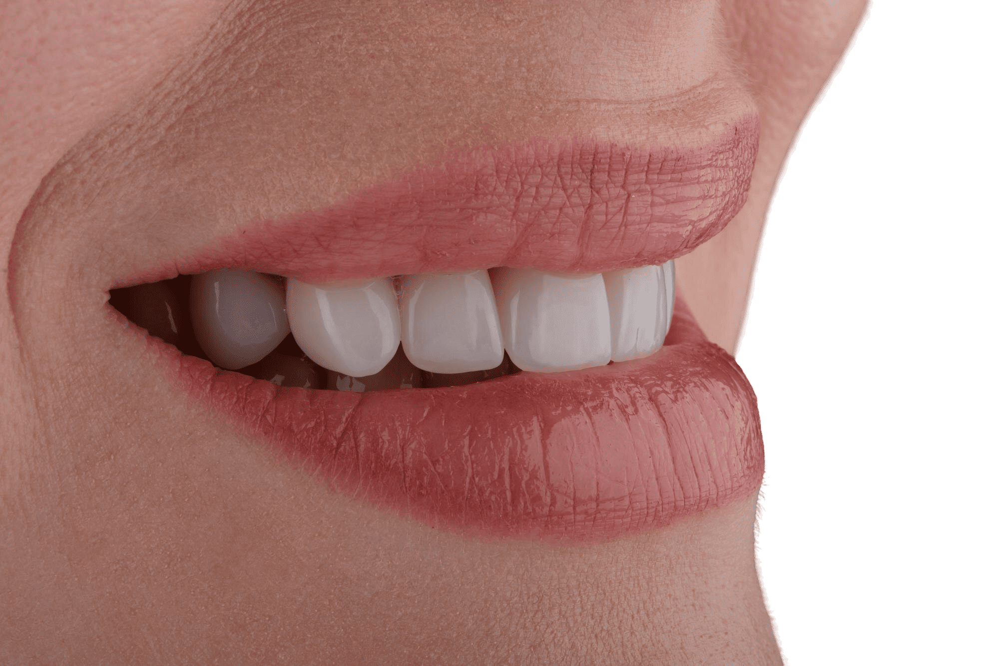 Carillas dentales de resina y cerámica en Cajicá