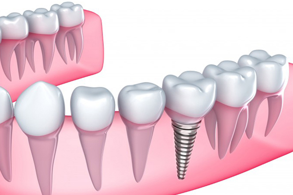 Implante dental en un solo día en Cajicá