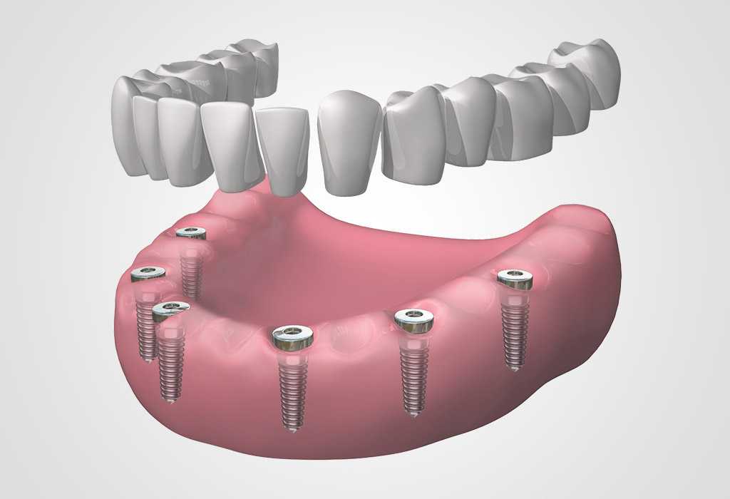 Implantes múltiples en Cajicá
