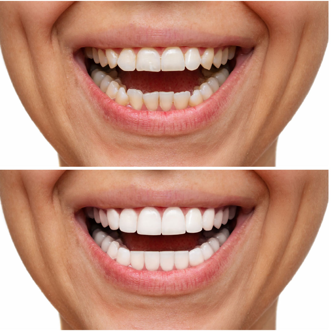 Caso real de diseño de sonrisa en Cajicá - antes y después 2