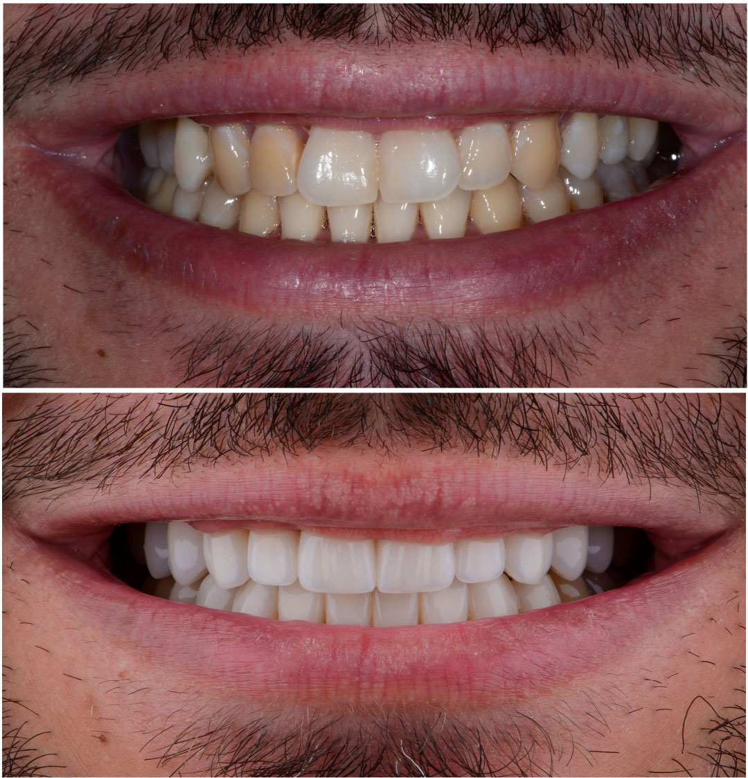 Caso real de diseño de sonrisa en Cajicá - antes y después 1