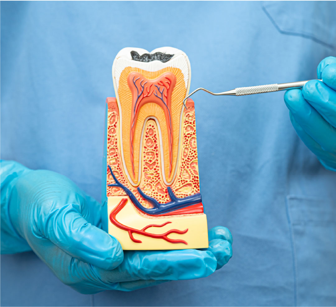 Endodoncia en Cajicá - tratamiento de conducto en Clínica Santa Bárbara