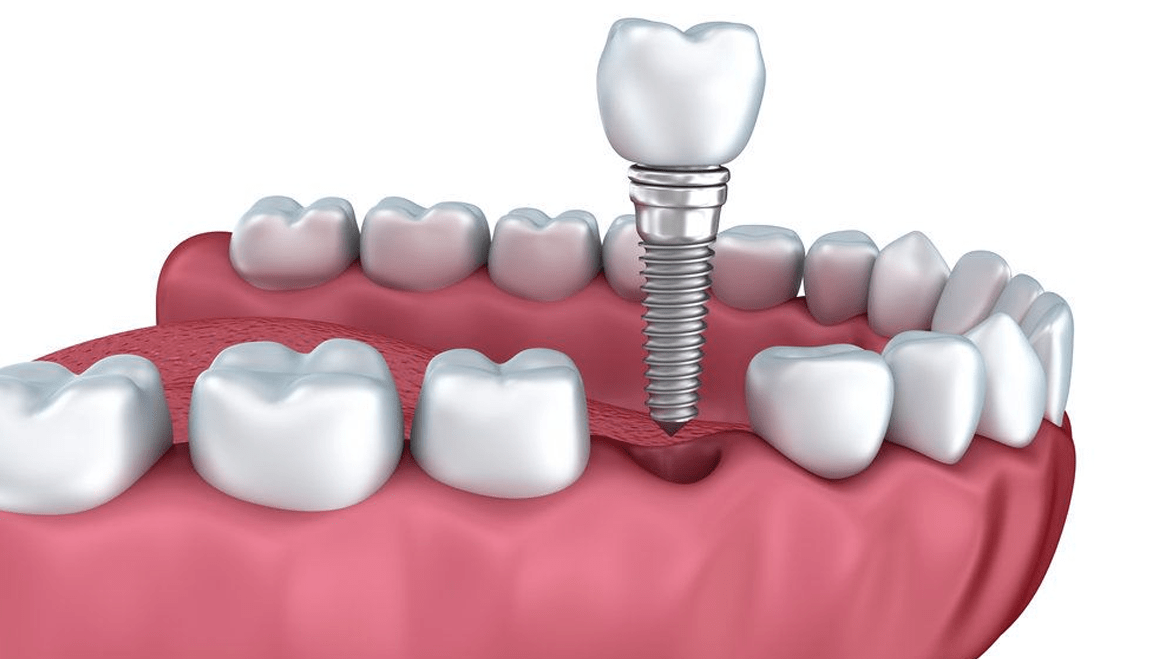 Estructura de un implante dental: corona, pilar y tornillo de titanio