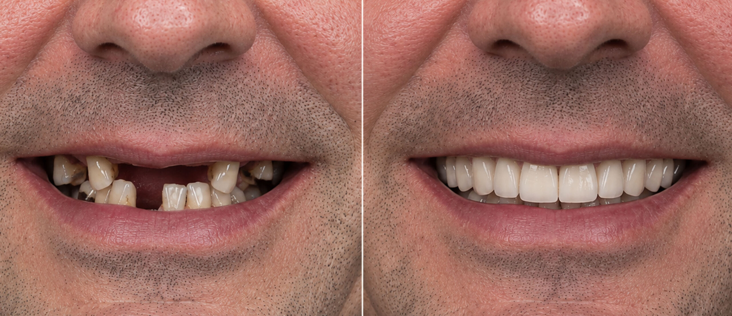 Caso real de implante dental en Cajicá - antes y después 3