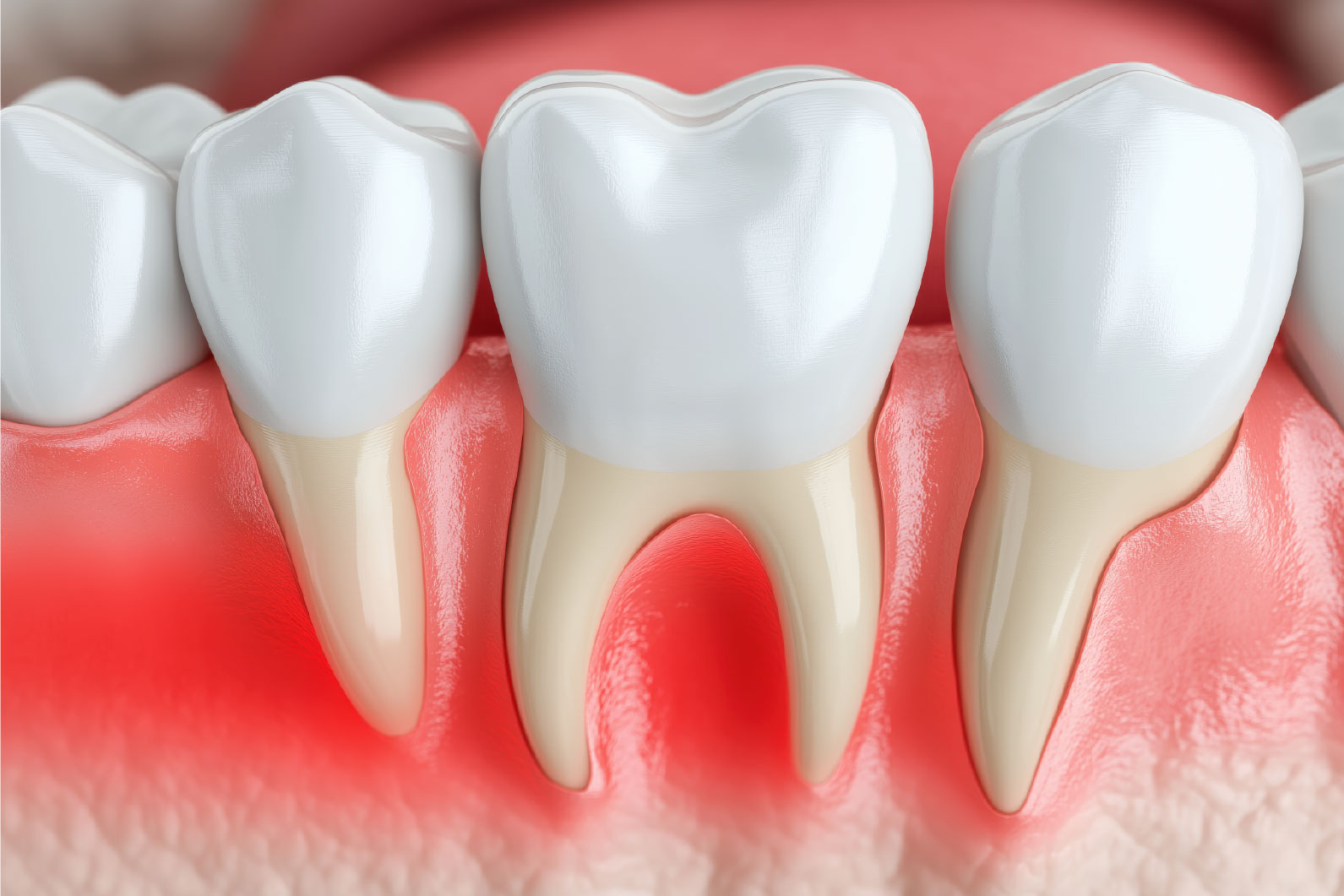 Encía inflamada por enfermedad periodontal