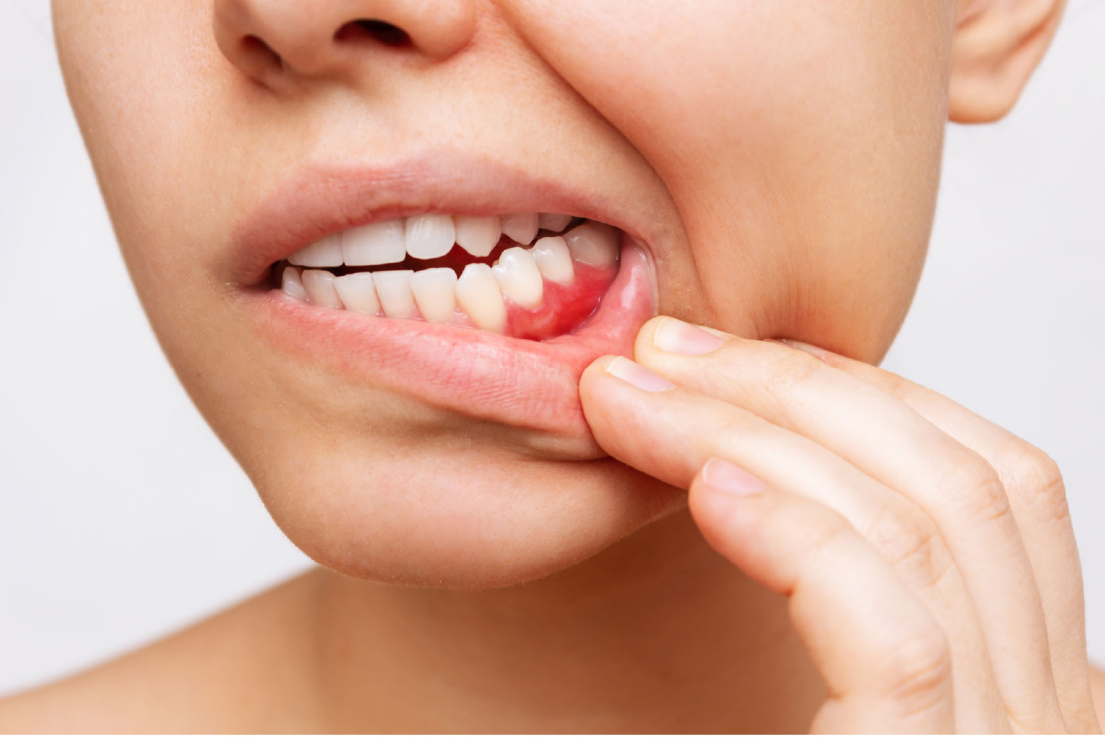 Encía inflamada - signo de periodontitis