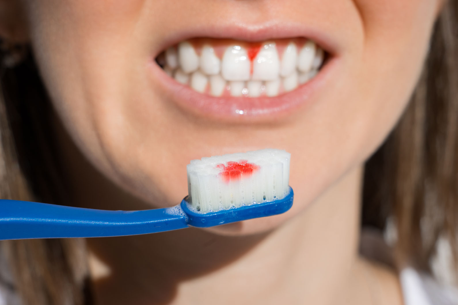 Sangrado en el cepillado por gingivitis