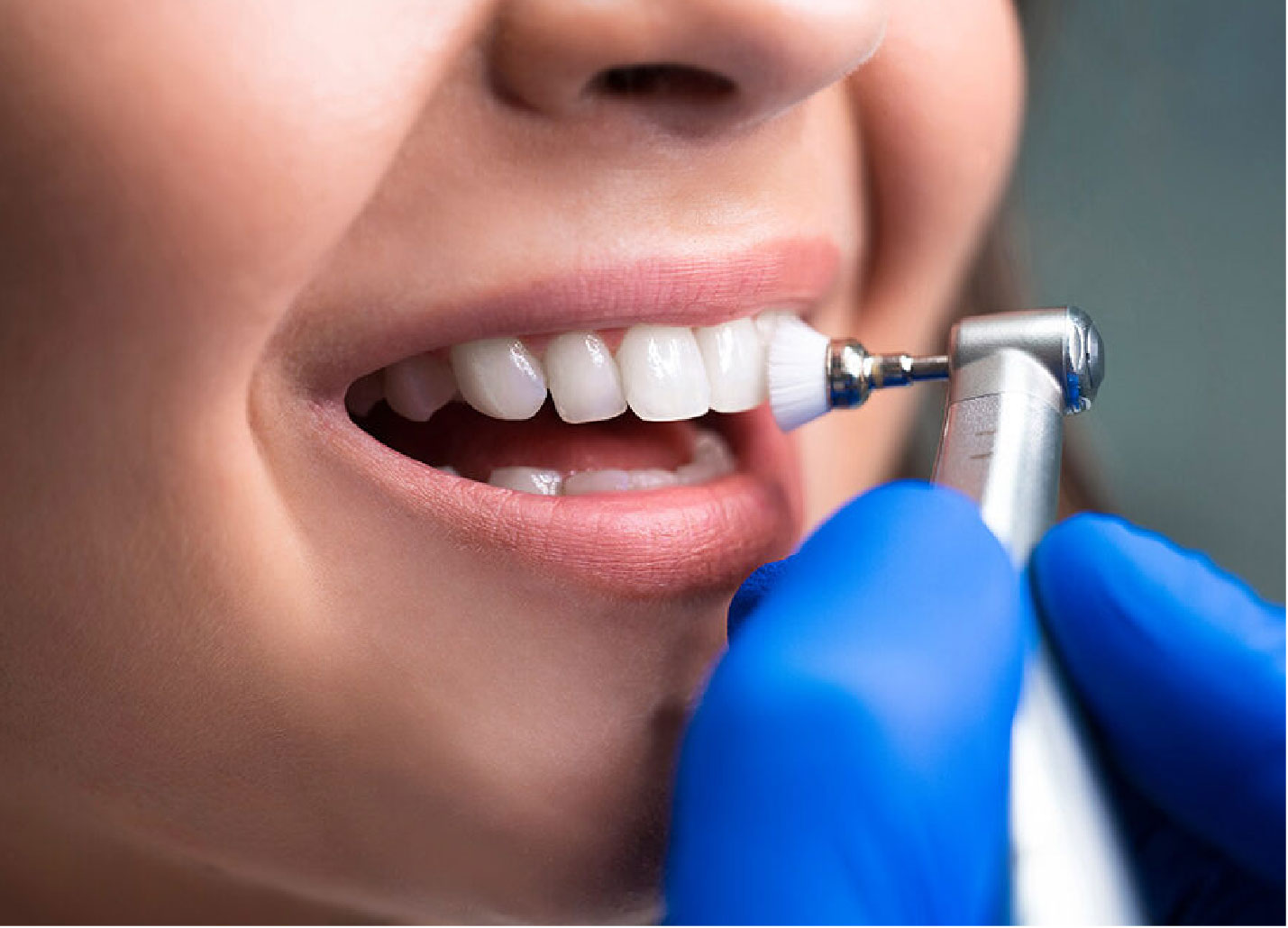 Limpieza dental profesional en Cajicá