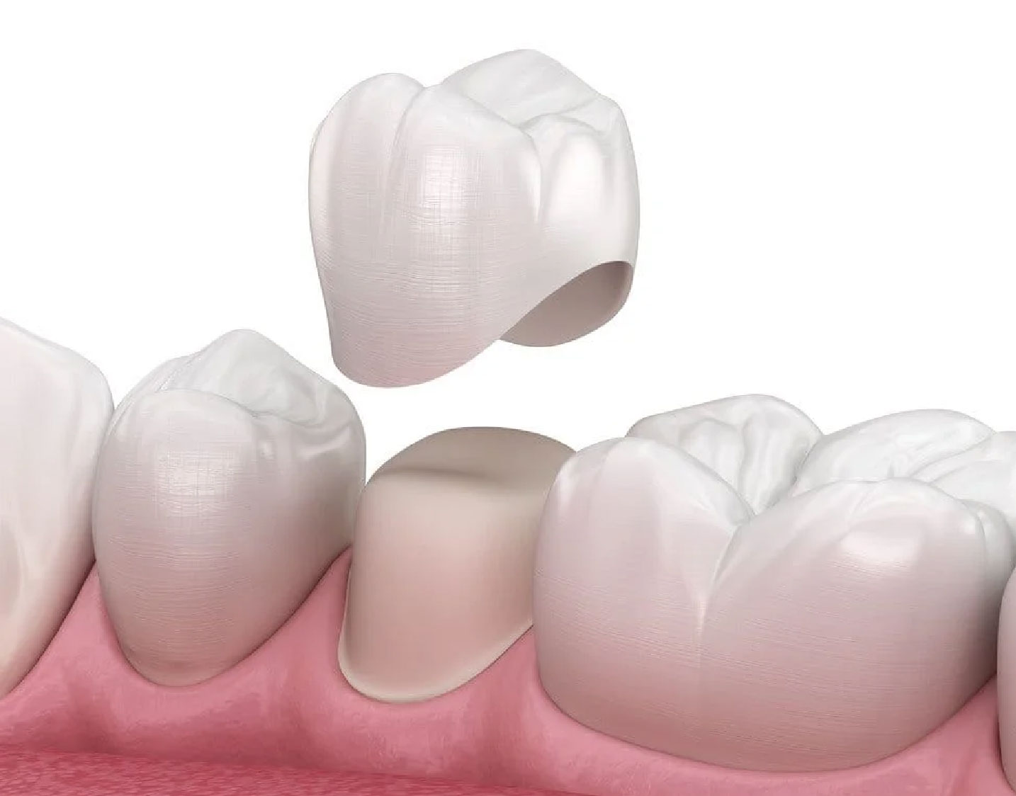 Prótesis dental fija en Cajicá - Clínica Santa Bárbara