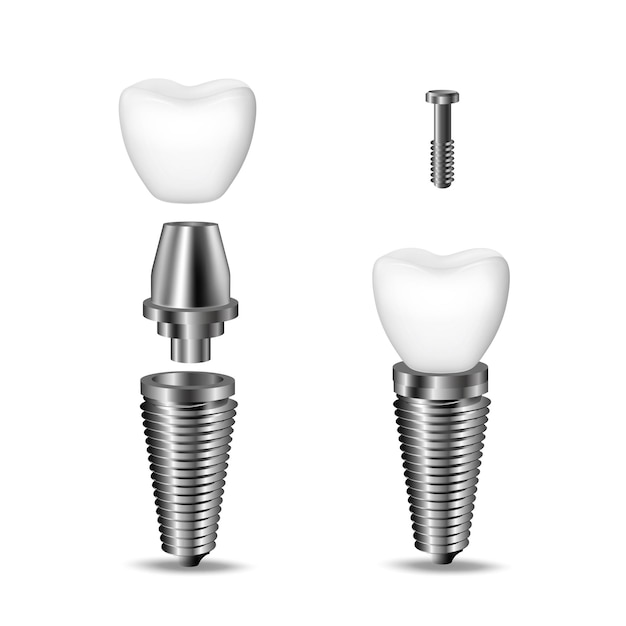 Reemplazo de dientes faltantes con implantes o coronas en Cajicá